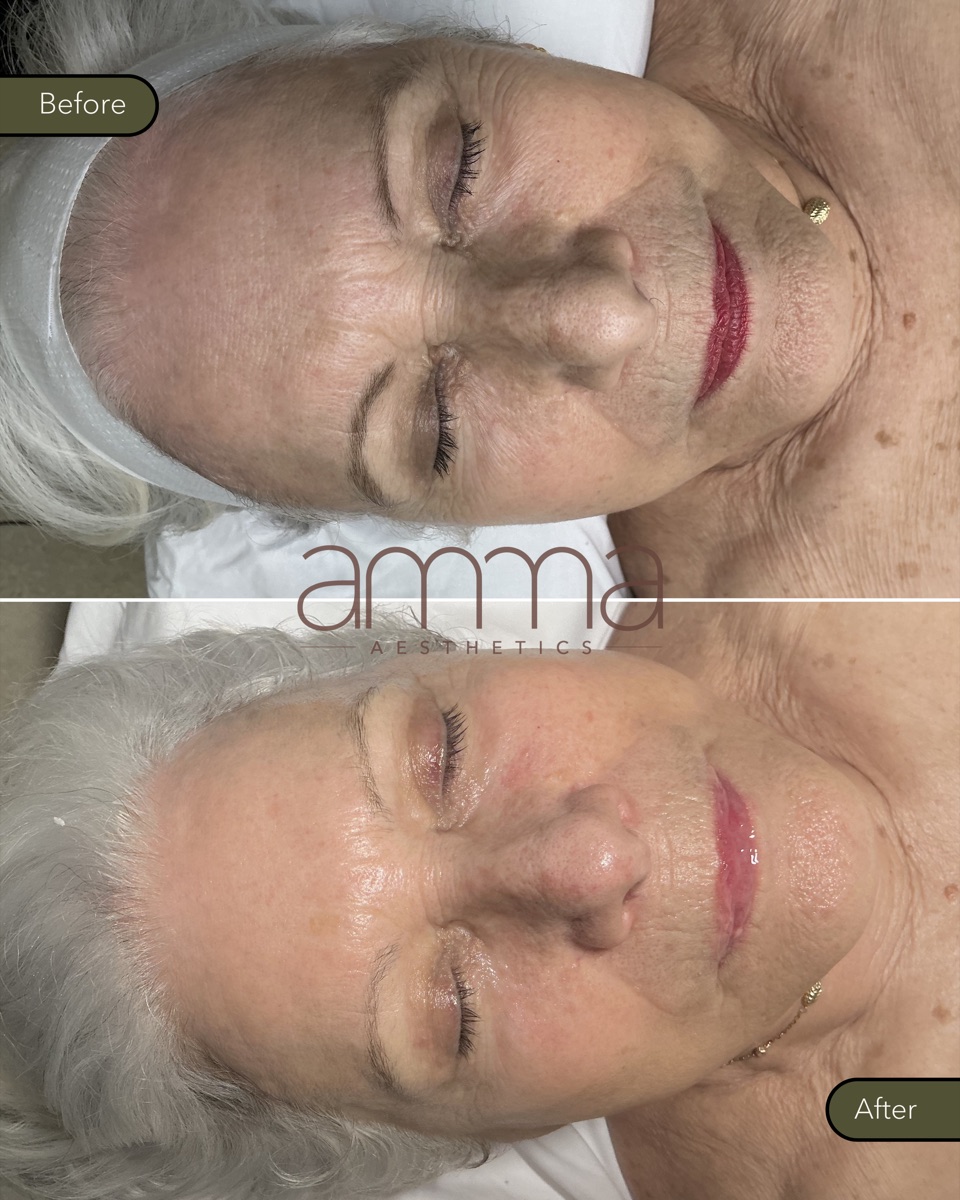 Skin rejuvenation before and after at AMMA Aesthetics
