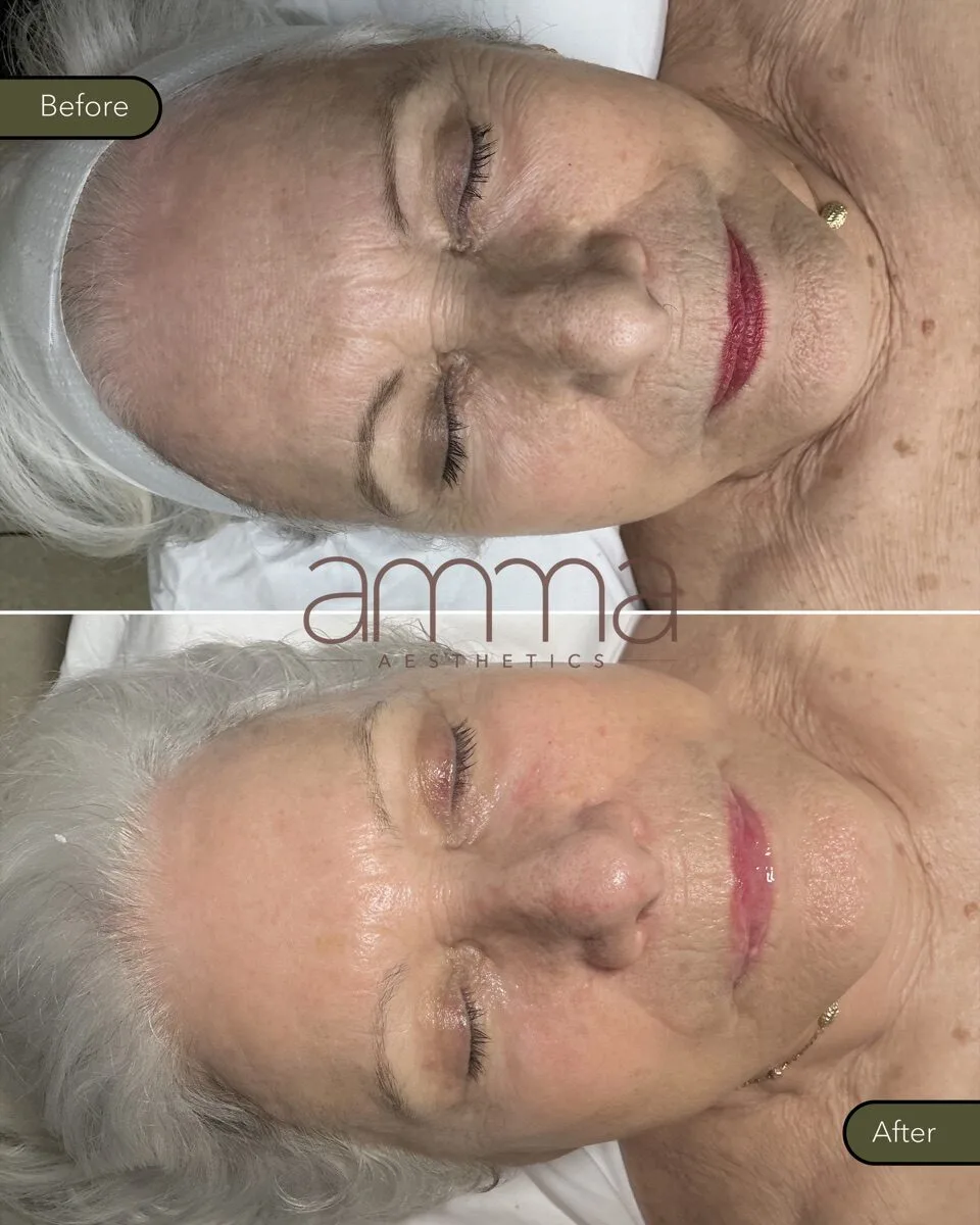 Skin rejuvenation before and after at AMMA Aesthetics