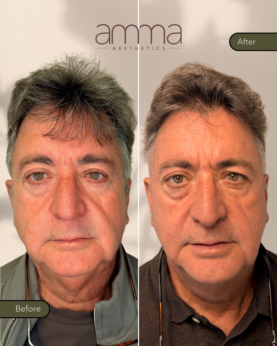 Facial rejuvenation before and after at AMMA Aesthetics