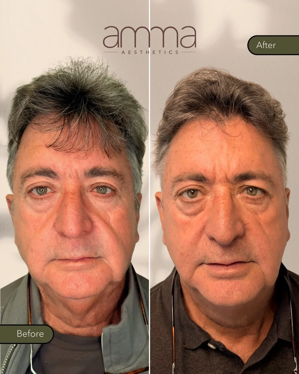 Facial rejuvenation before and after at AMMA Aesthetics