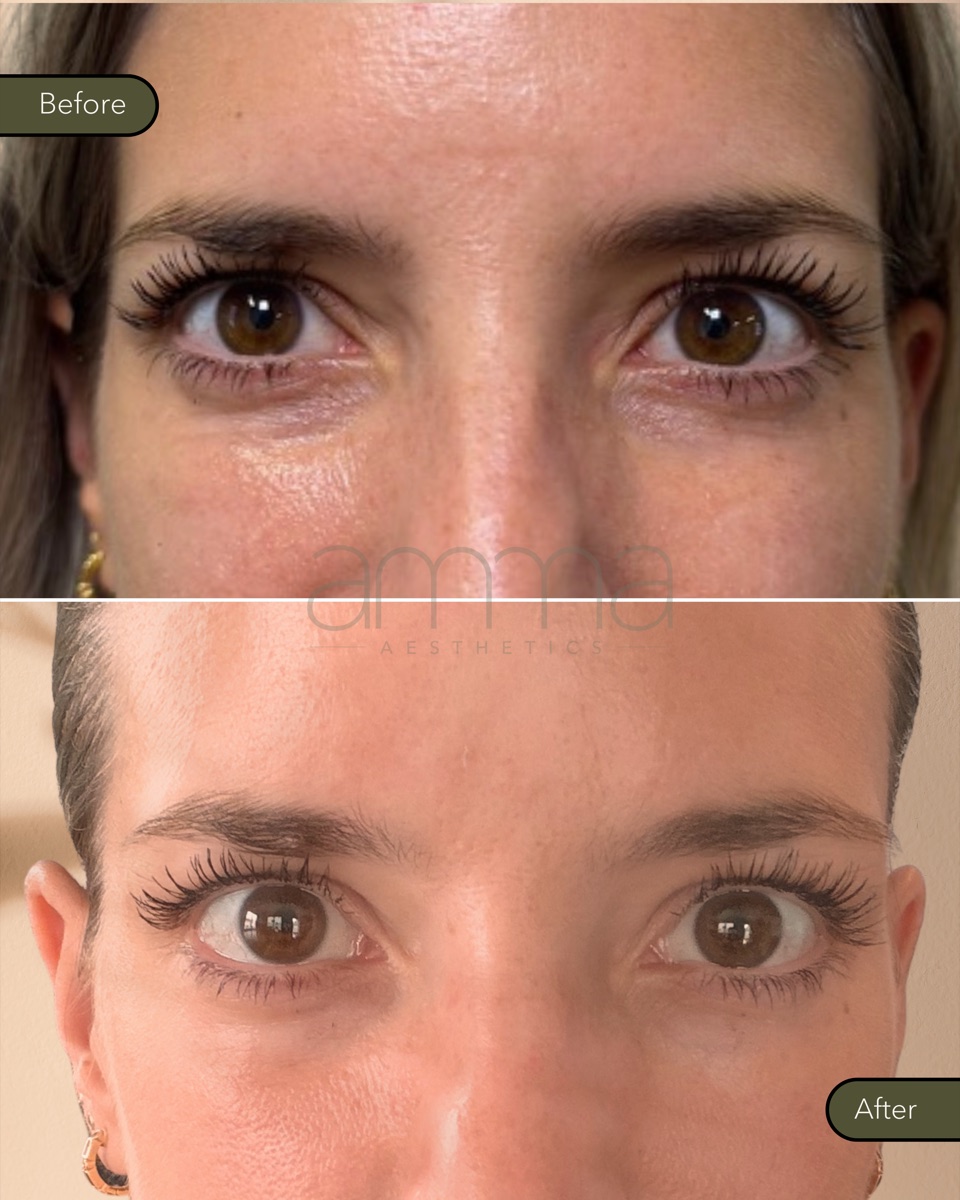 EZGel under-eye before and after at AMMA Aesthetics