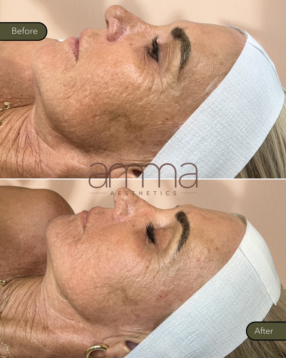 Skin rejuvenation before and after at AMMA Aesthetics