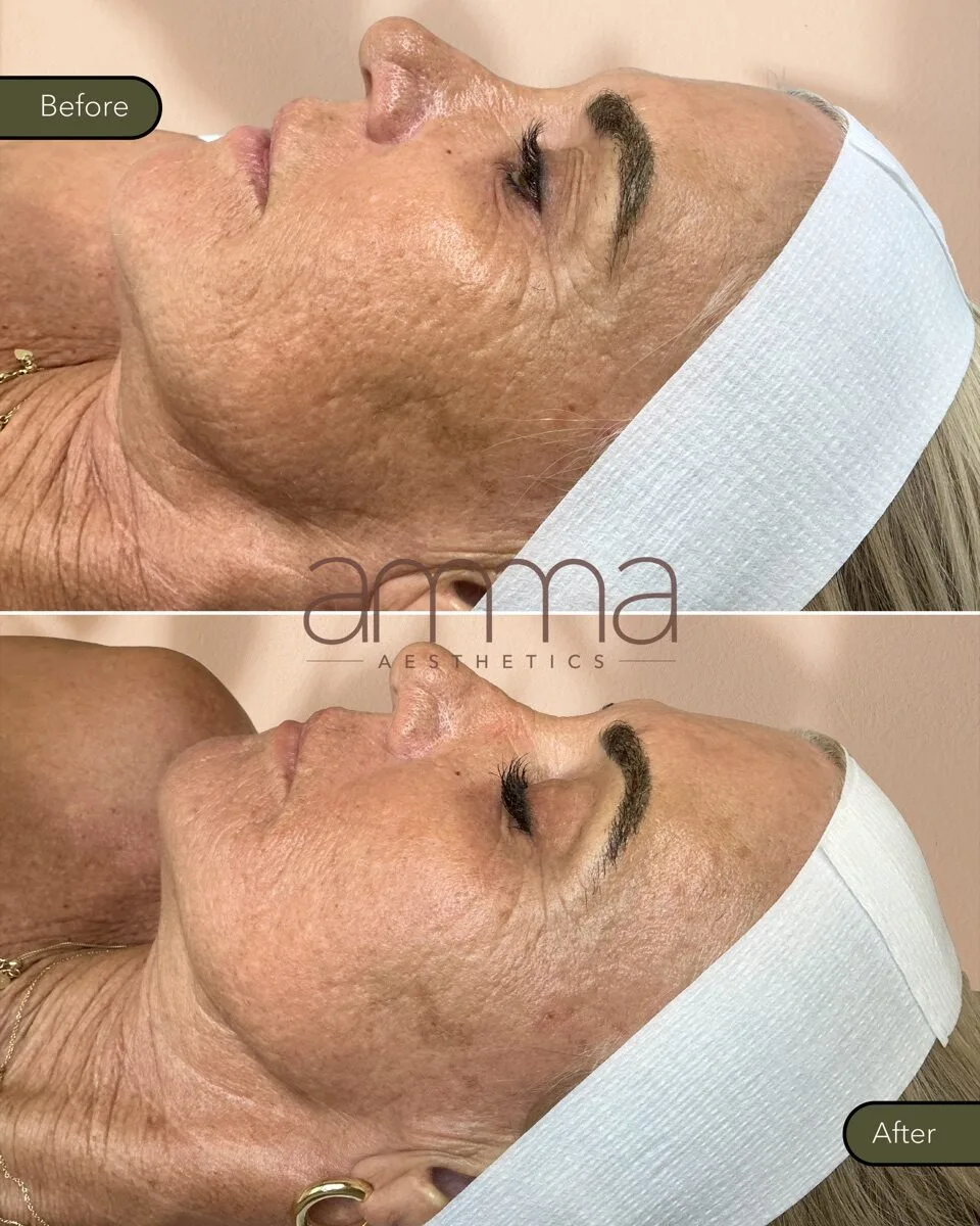 Skin rejuvenation before and after at AMMA Aesthetics