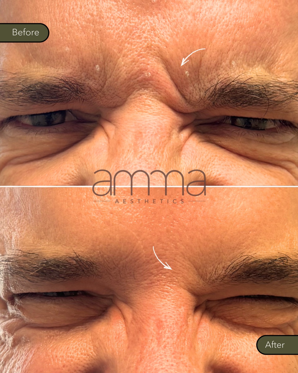Botox before and after at AMMA Aesthetics