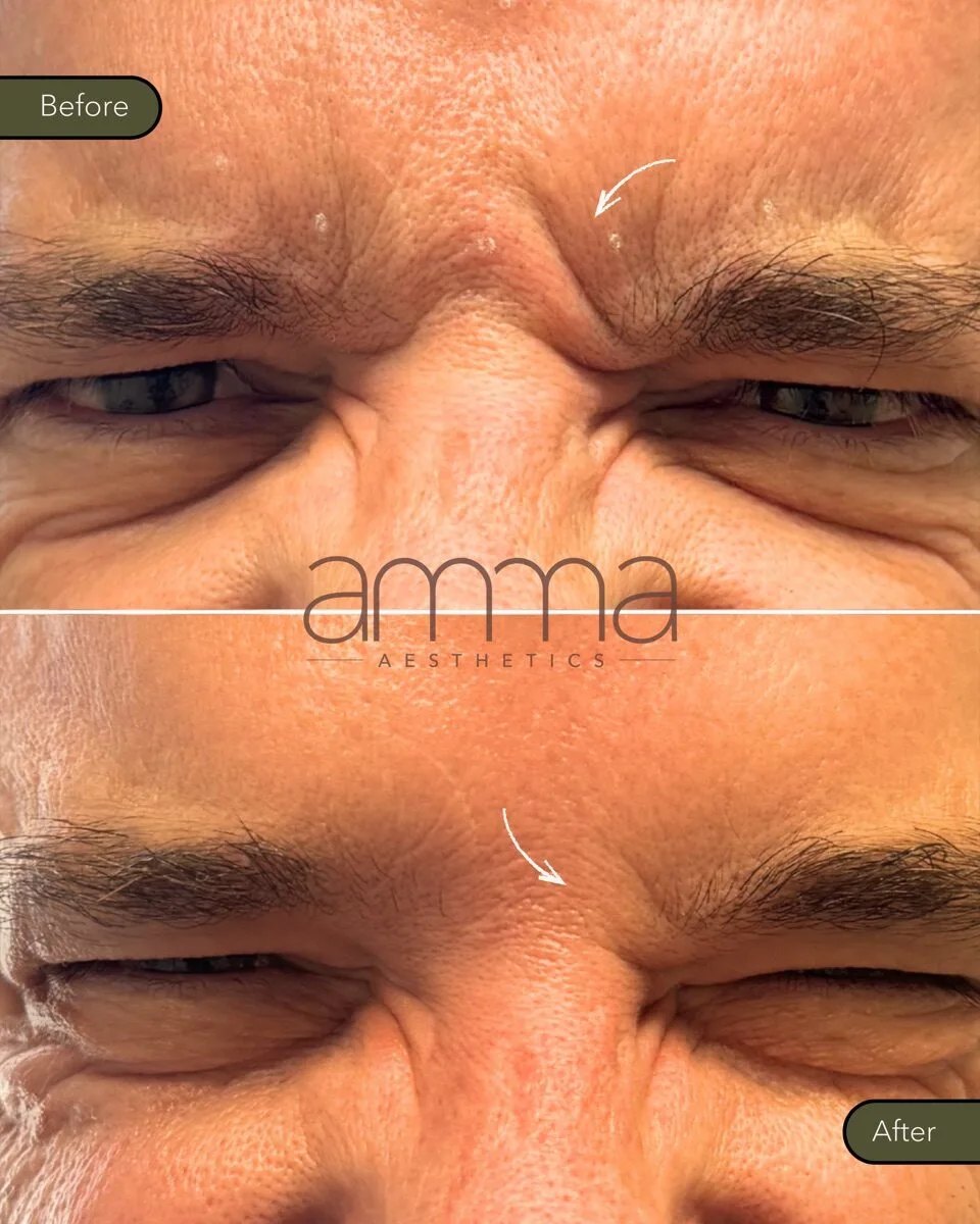 Botox before and after at AMMA Aesthetics