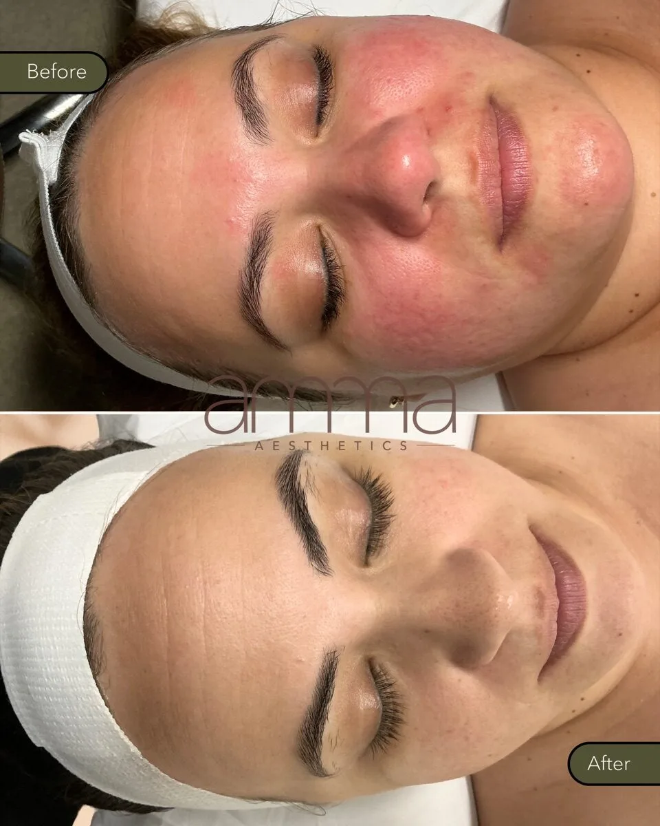 Skin rejuvenation before and after at AMMA Aesthetics