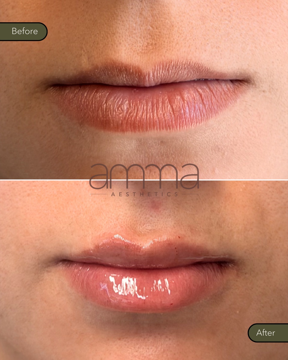 Lip filler before and after at AMMA Aesthetics