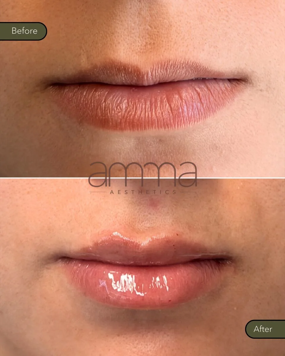 Lip filler before and after at AMMA Aesthetics