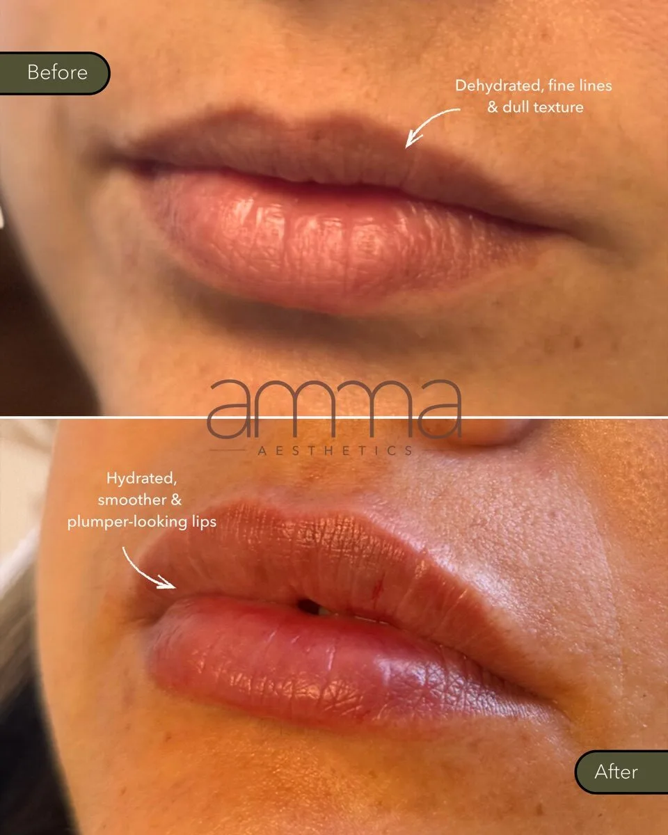 Lip filler before and after at AMMA Aesthetics