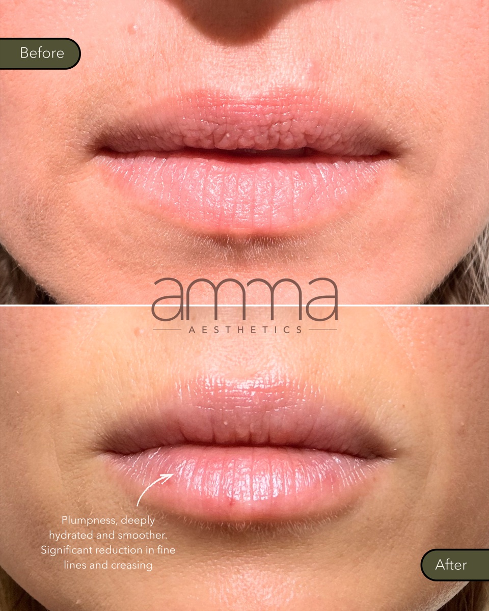 Lip filler before and after at AMMA Aesthetics