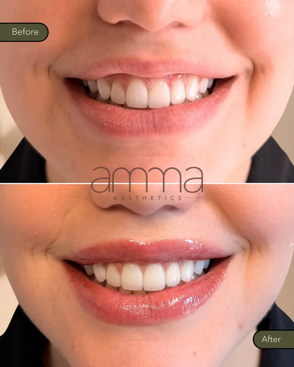 Lip filler before and after at AMMA Aesthetics