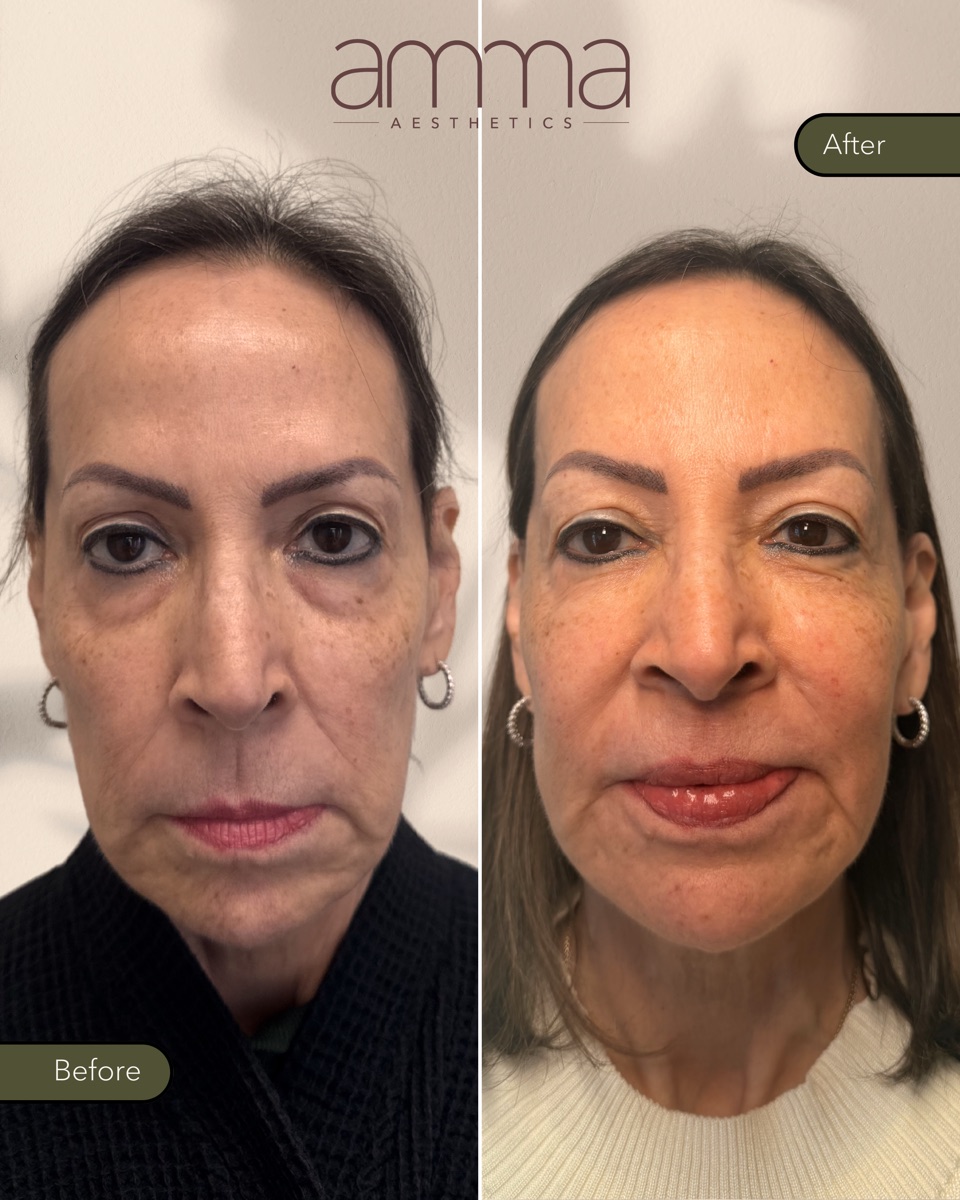 Facial rejuvenation before and after at AMMA Aesthetics