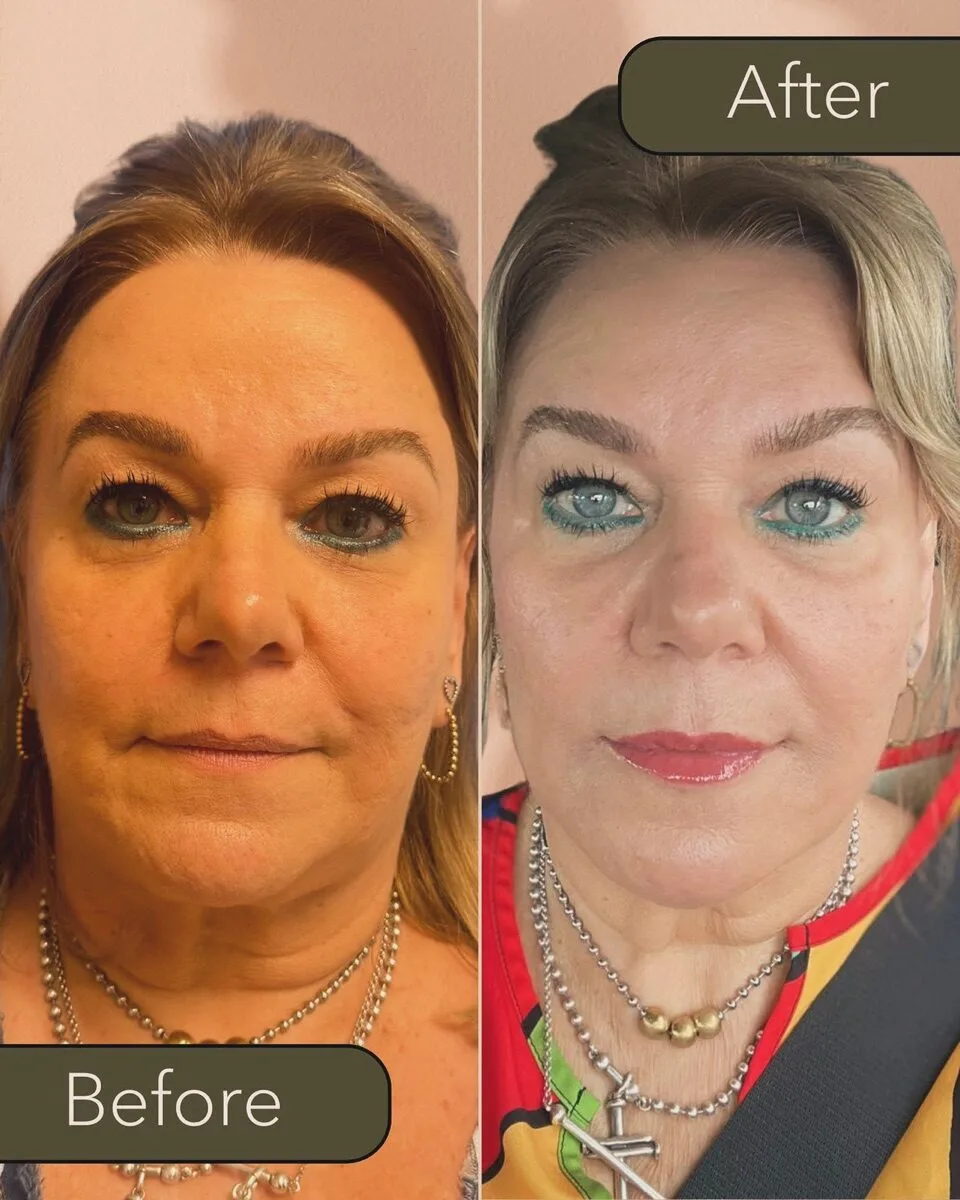 Facial rejuvenation before and after at AMMA Aesthetics
