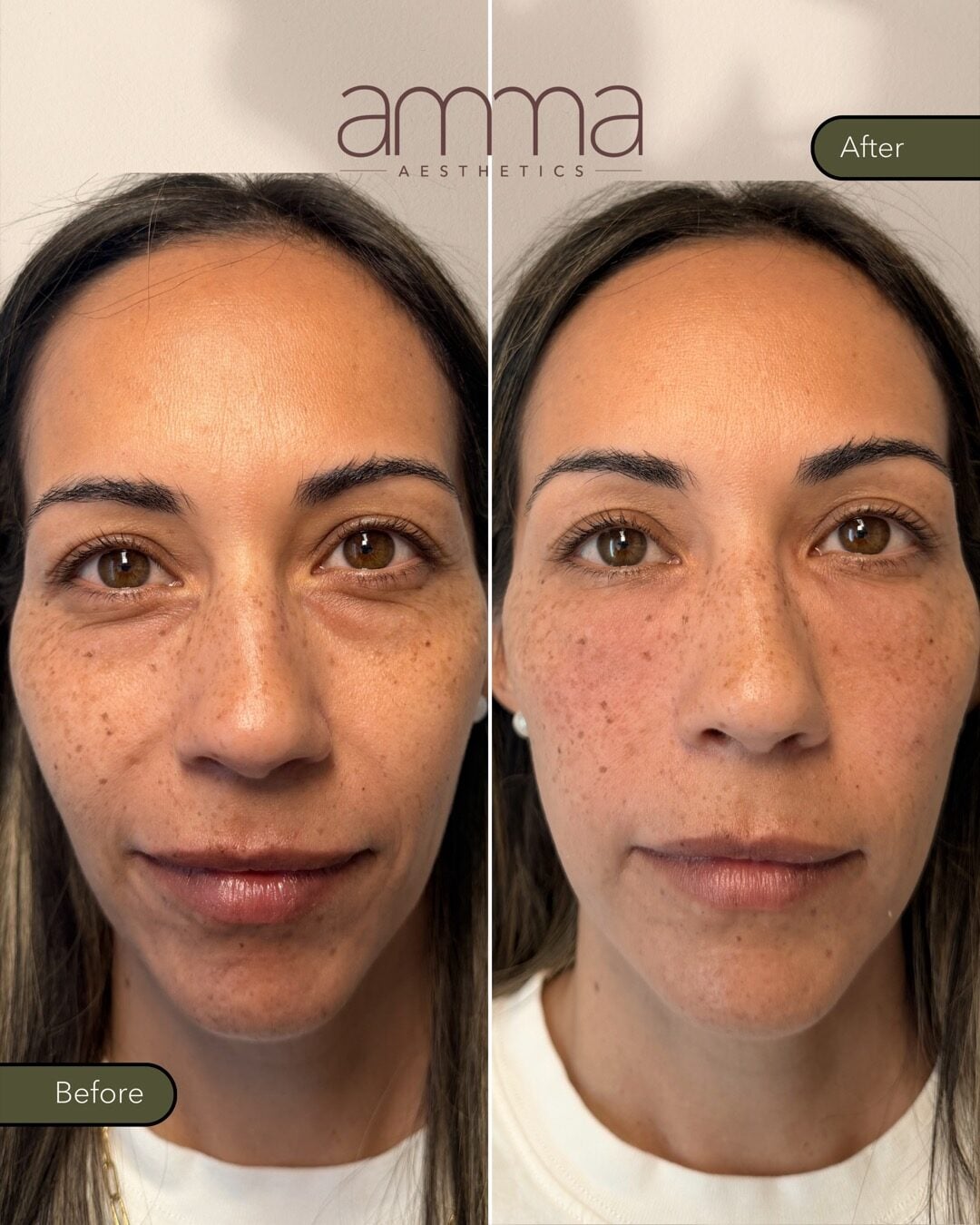 Noelia Nunez EZGel before and after at AMMA Aesthetics
