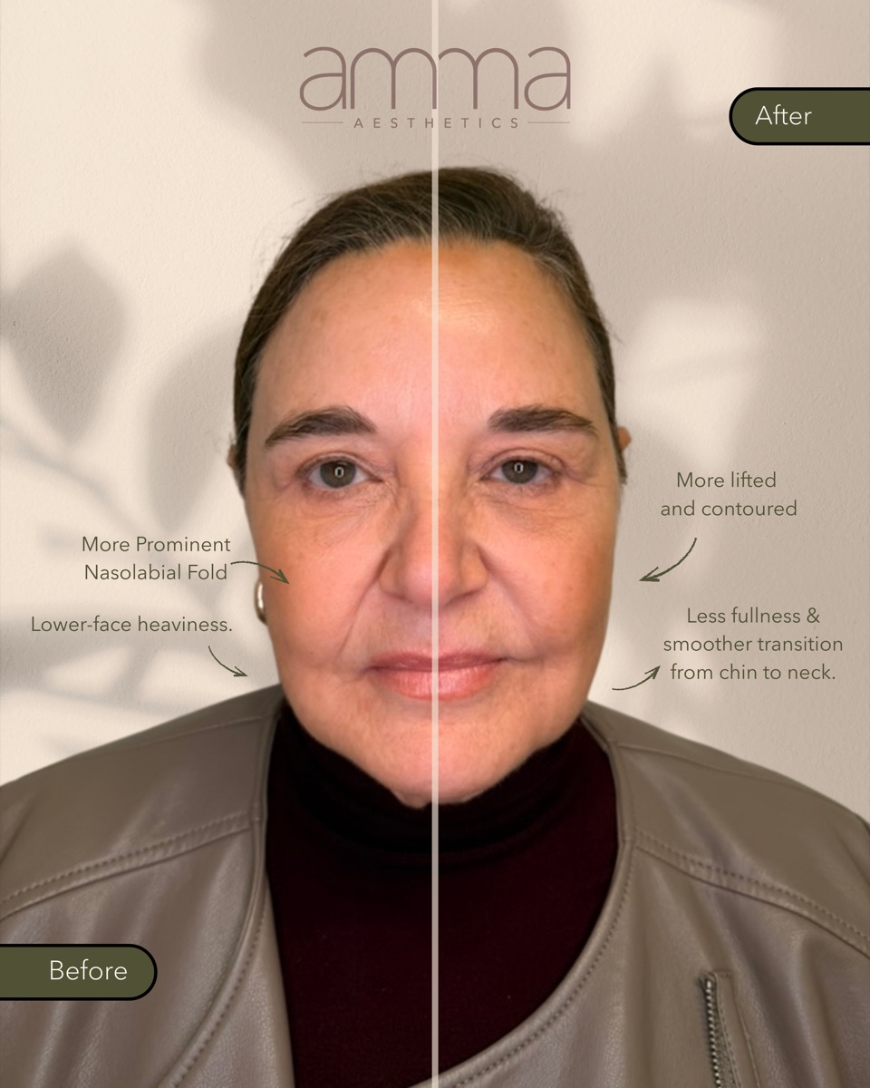 Sculptra before and after at AMMA Aesthetics