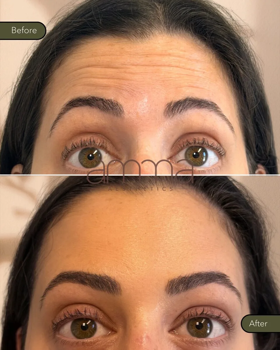 Botox before and after at AMMA Aesthetics