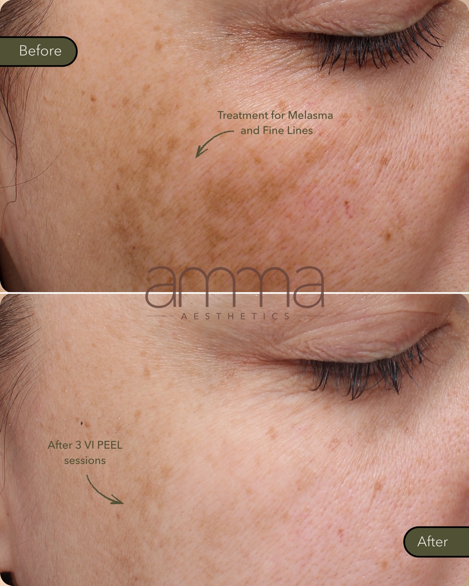 VI Peel before and after at AMMA Aesthetics