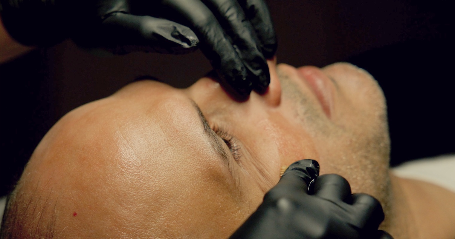 Chemical Peels