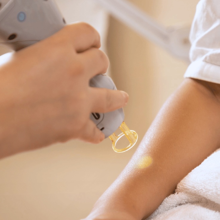 Laser hair removal treatment on the legs at AMMA Aesthetics in South Miami