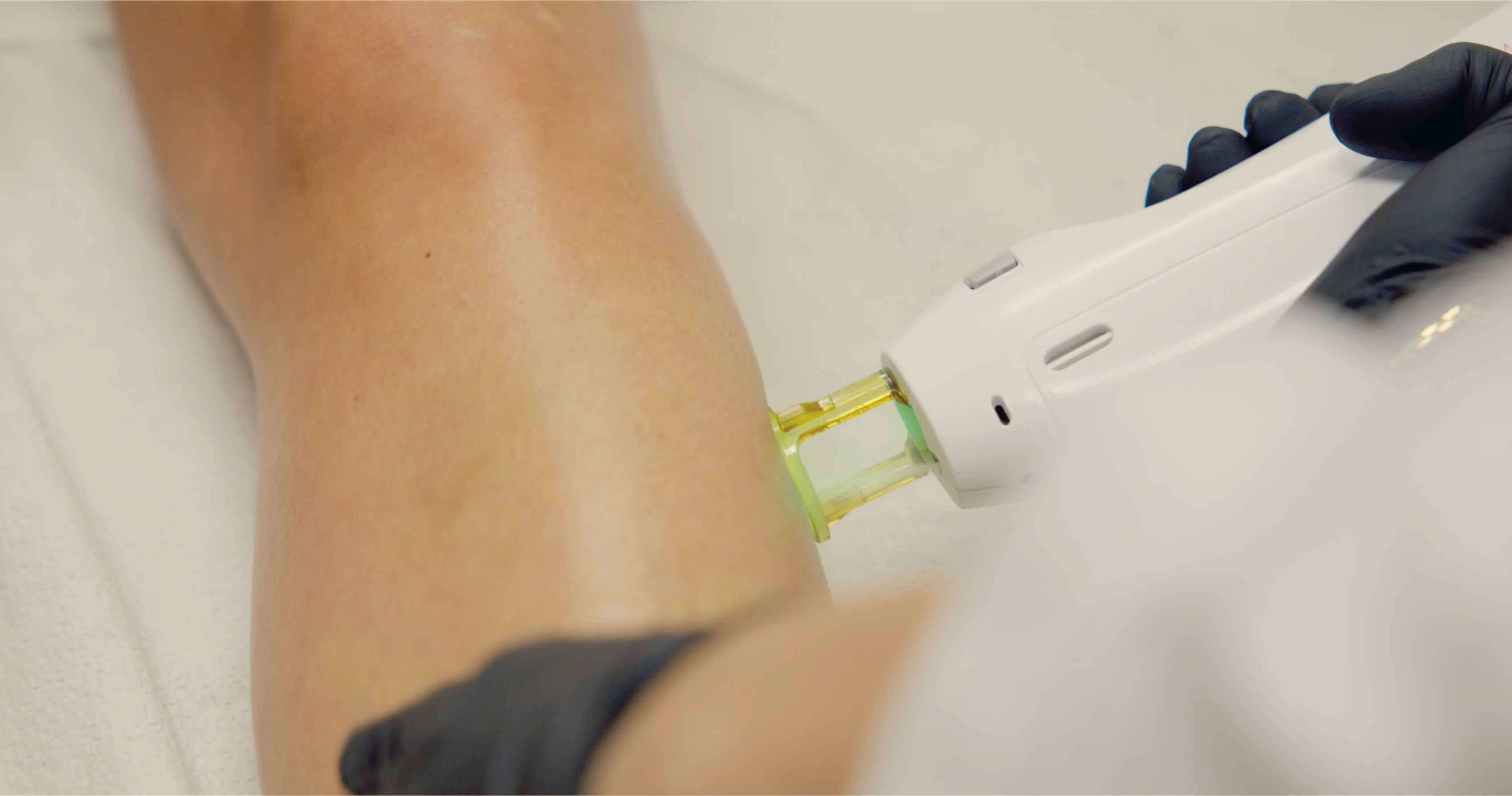 Laser hair removal vs. waxing vs. shaving compared at AMMA Aesthetics in South Miami