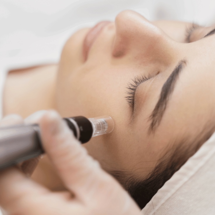 RF microneedling versus traditional microneedling treatment at AMMA Aesthetics in South Miami