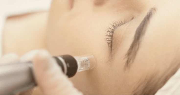 Microneedling with PRP vampire facial treatment at AMMA Aesthetics in South Miami