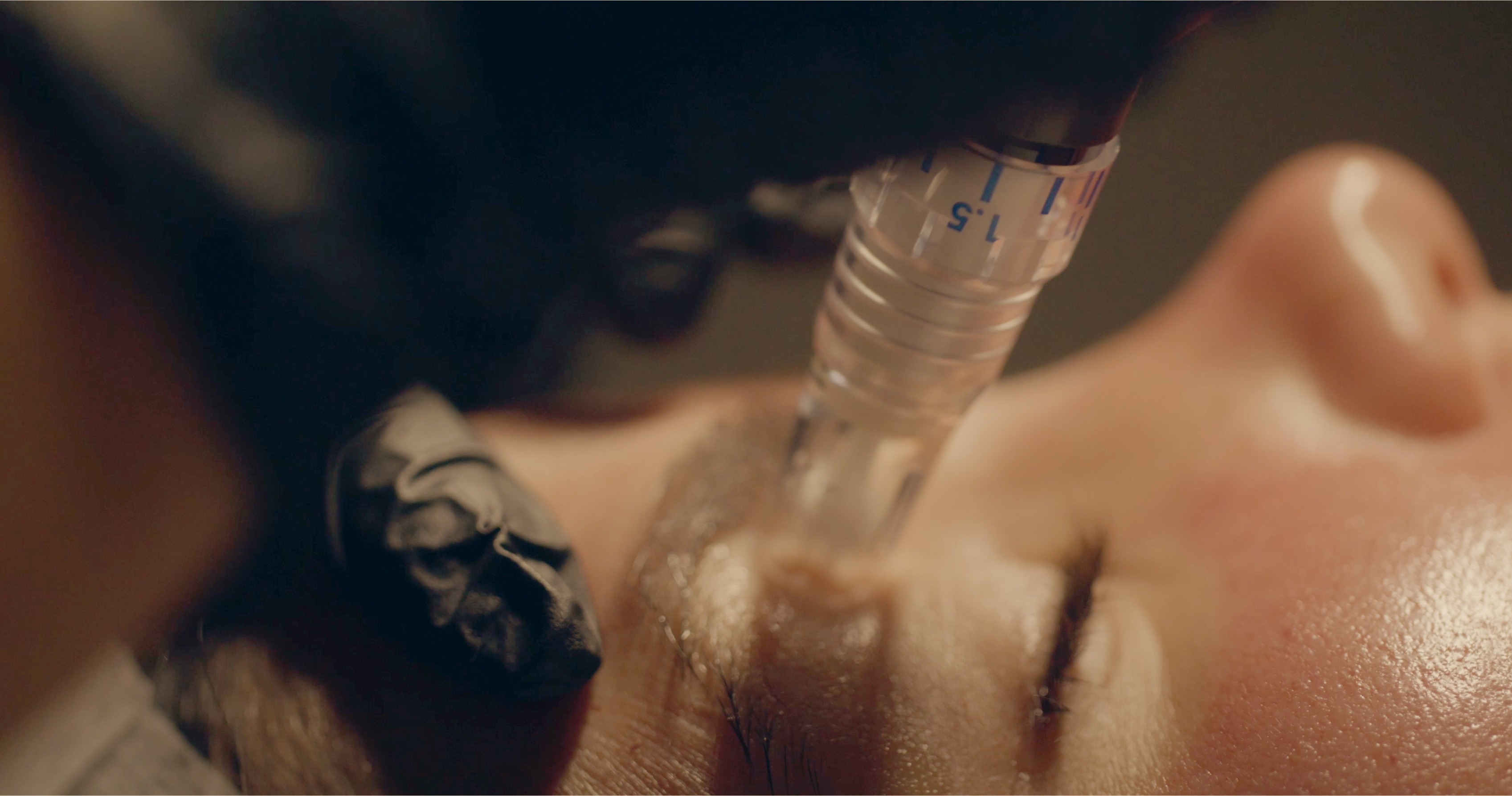 Microneedling