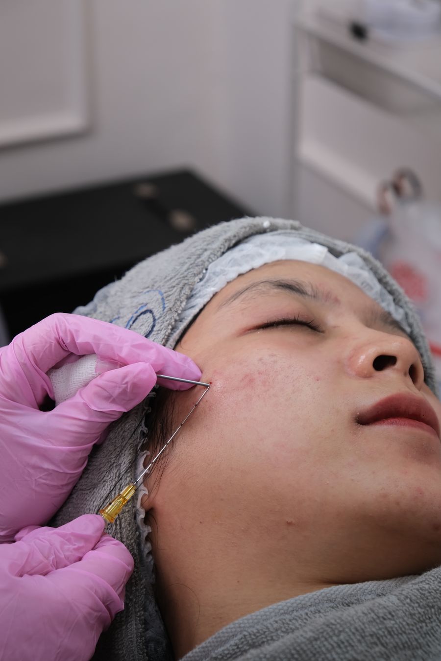Microneedling collagen induction treatment for smoother skin texture at AMMA Aesthetics in South Miami