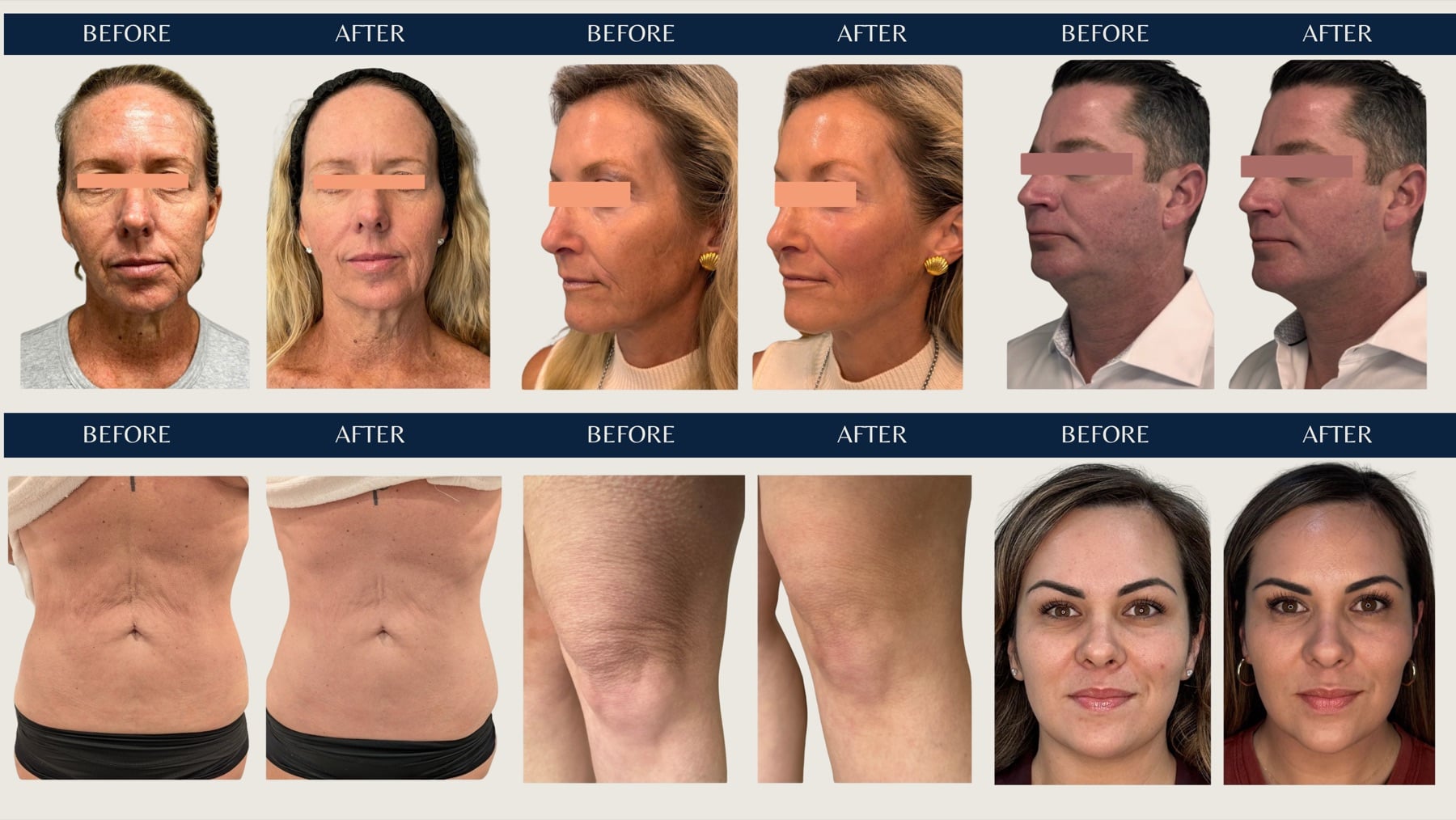 Everesse RF skin tightening before and after results on the face, neck, abdomen, knees and body