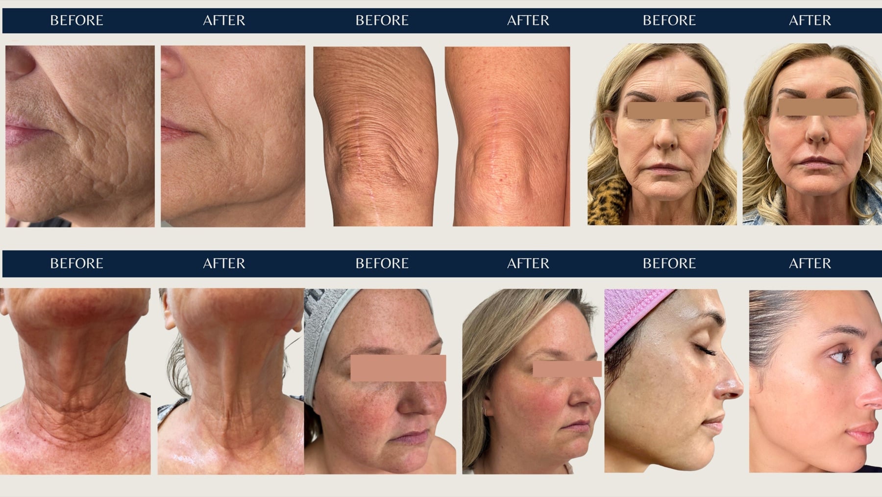 Tetra Pro CO2 laser and CoolPeel before and after results on the face, neck, and skin texture