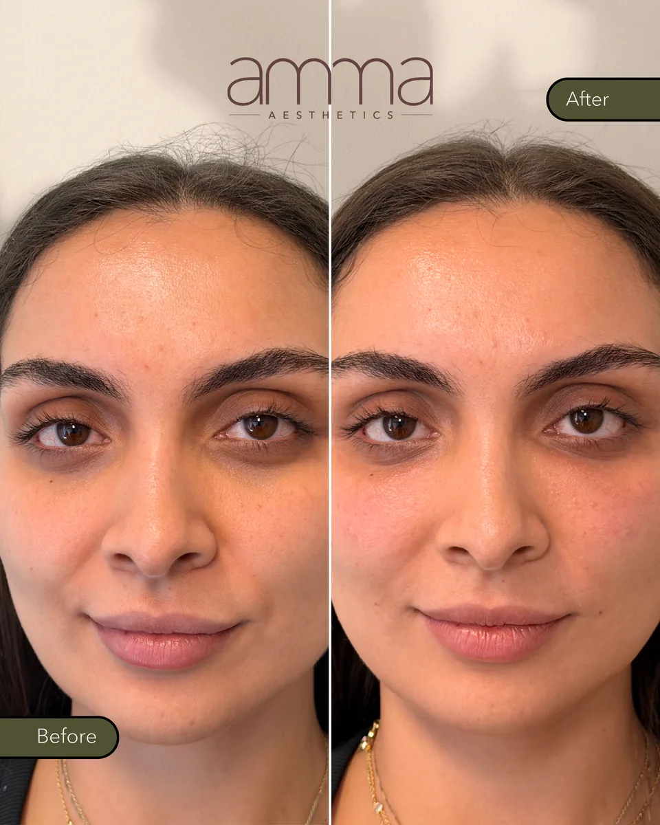 EZGel under-eye before and after at AMMA Aesthetics