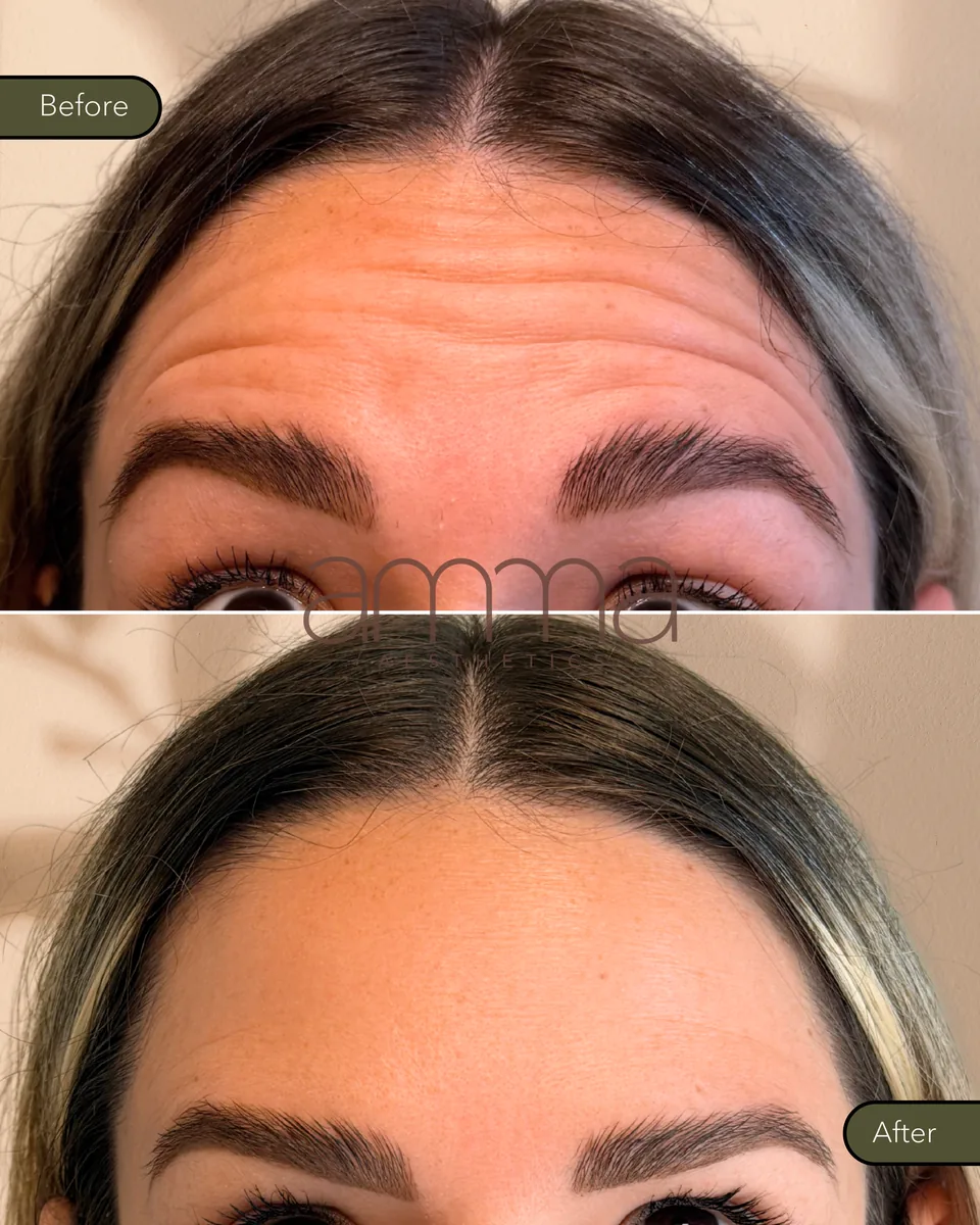 Botox before and after at AMMA Aesthetics