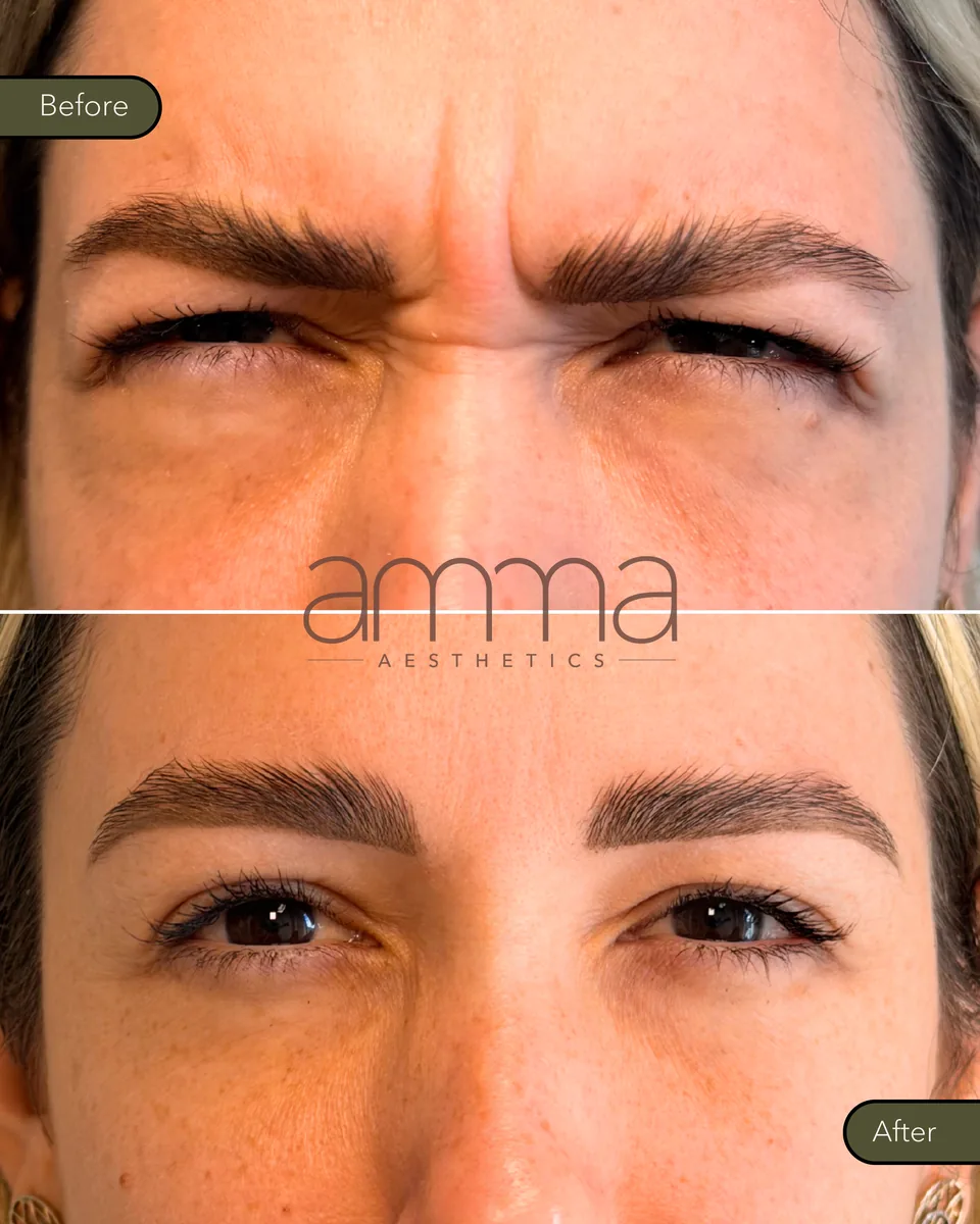 Botox before and after at AMMA Aesthetics