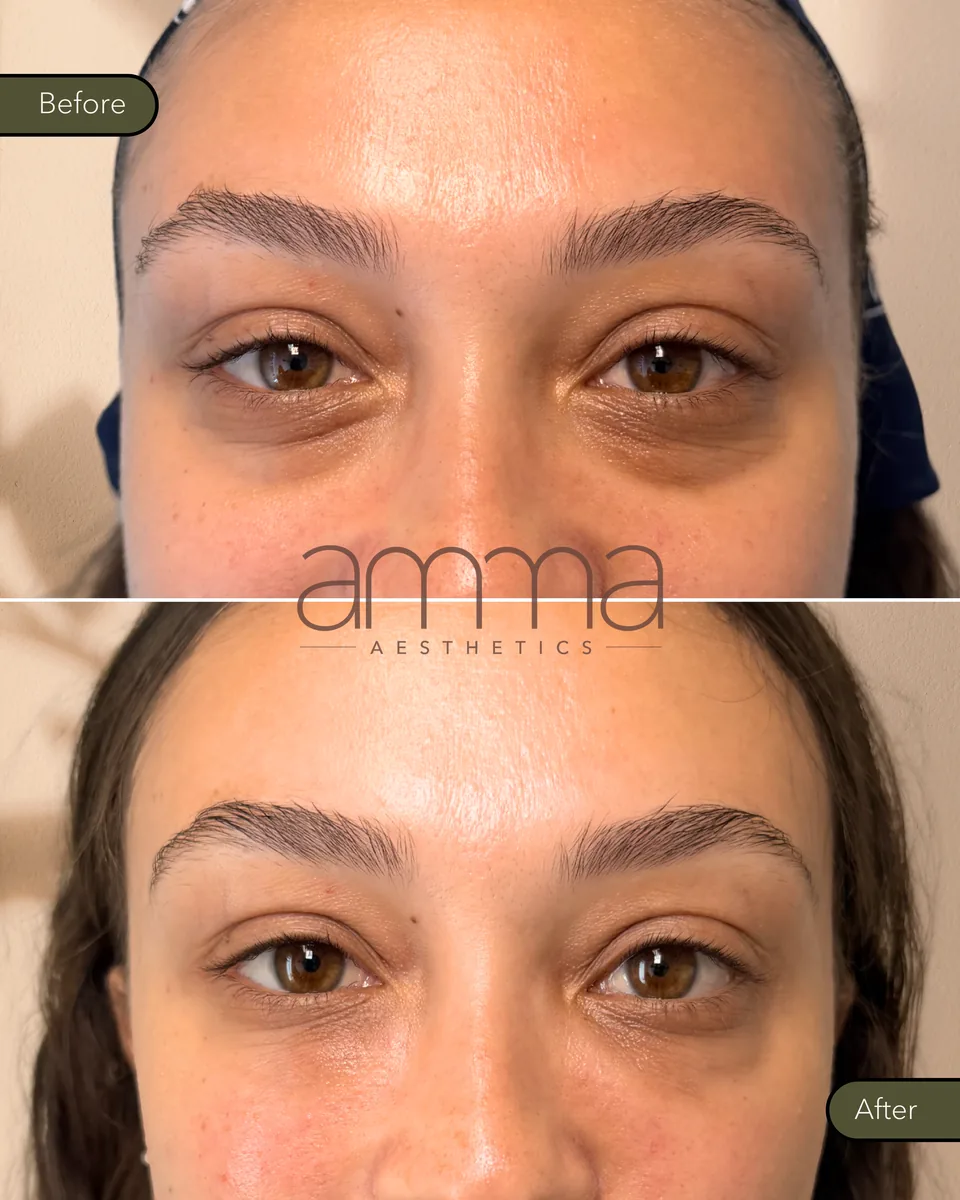 EZGel under-eye before and after at AMMA Aesthetics