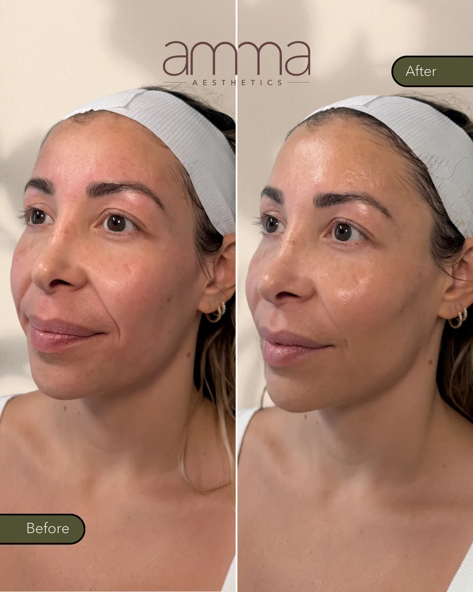 Sculptra before and after at AMMA Aesthetics