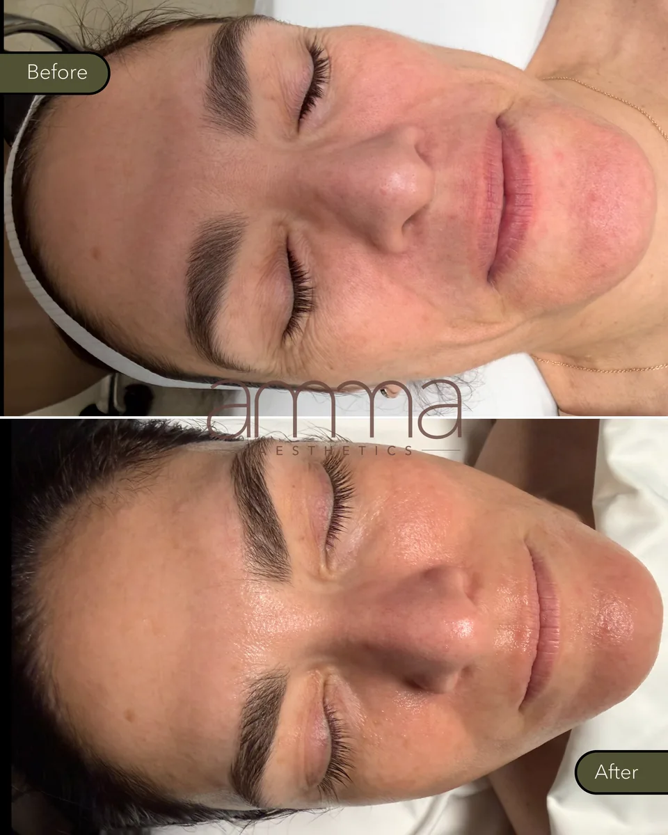 Under-eye rejuvenation before and after at AMMA Aesthetics