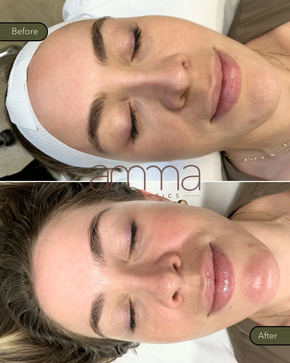 Skin rejuvenation before and after at AMMA Aesthetics