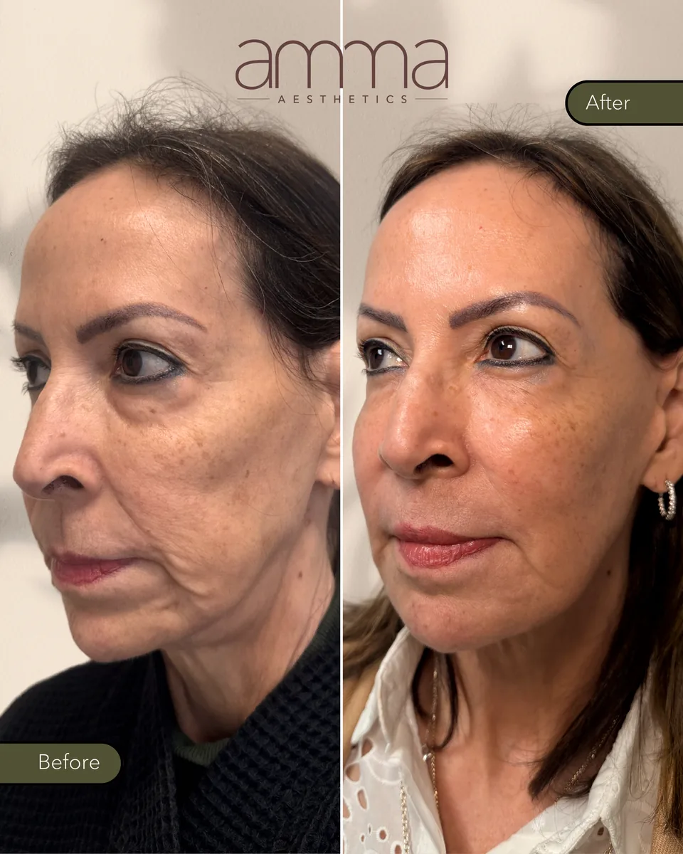 Facial rejuvenation before and after at AMMA Aesthetics