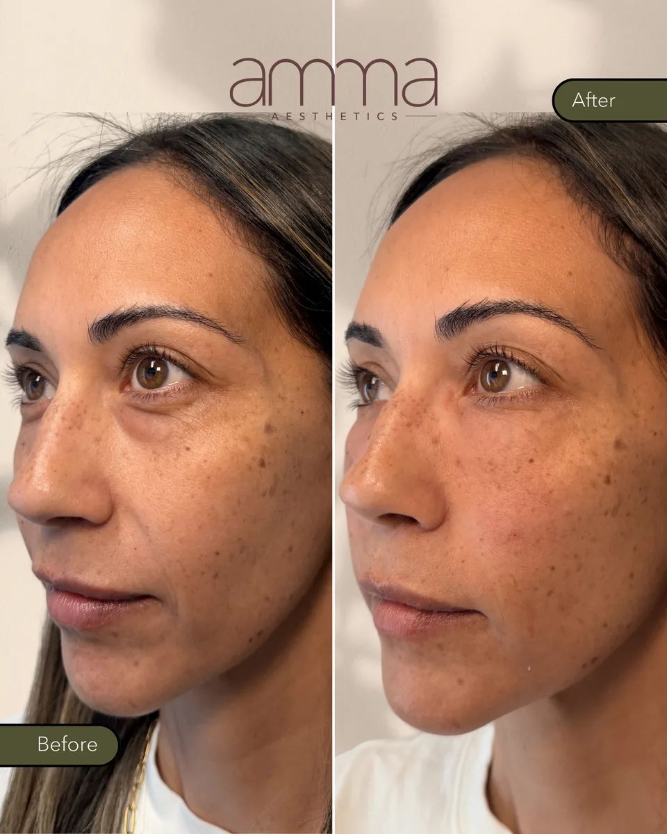 EZGel skin rejuvenation before and after at AMMA Aesthetics