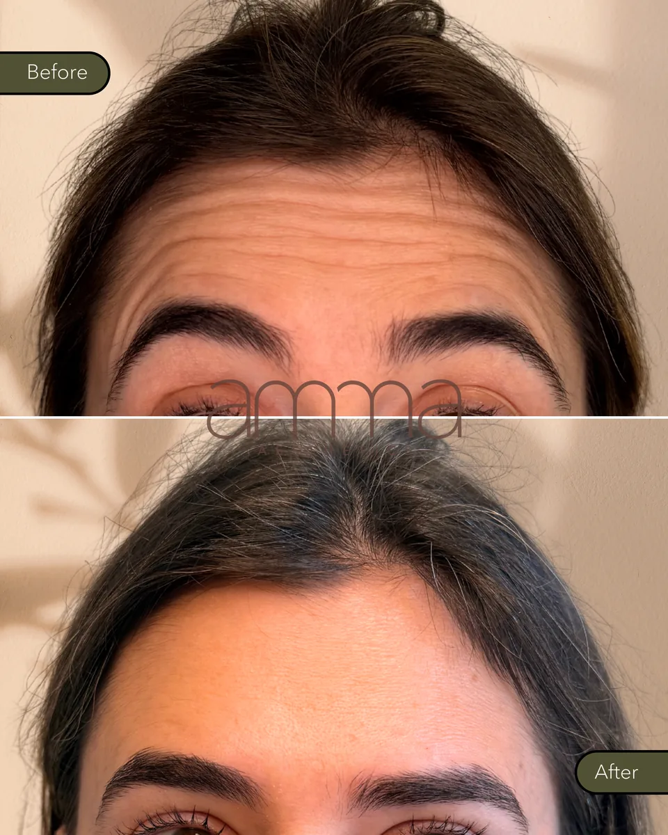 Botox before and after at AMMA Aesthetics