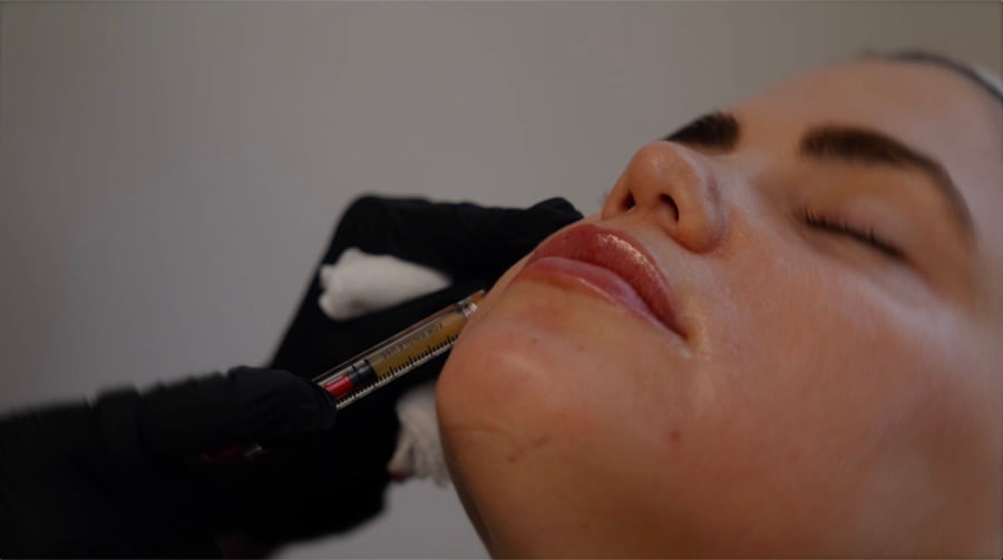 EZ Gel PRF Injections at AMMA Aesthetics in South Miami