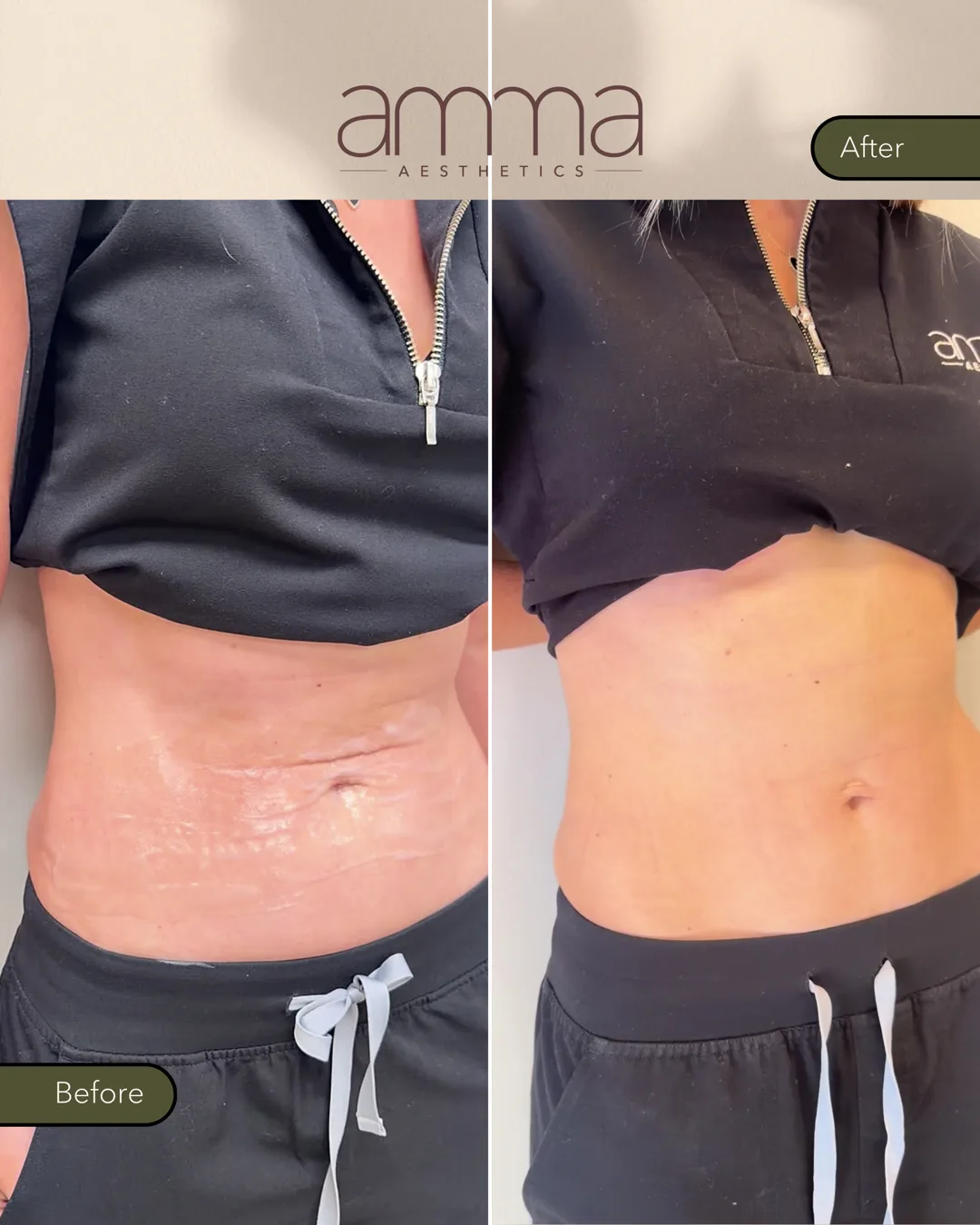 Everesse RF skin tightening abdomen before and after, angled view, at AMMA Aesthetics