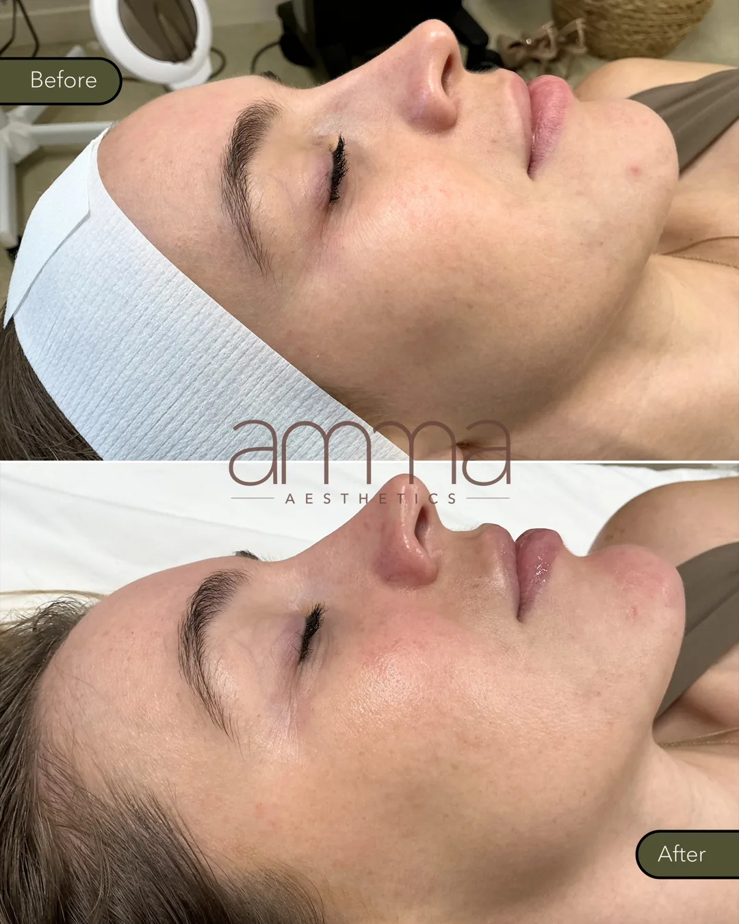 HydraFacial before and after, angled view, at AMMA Aesthetics in South Miami