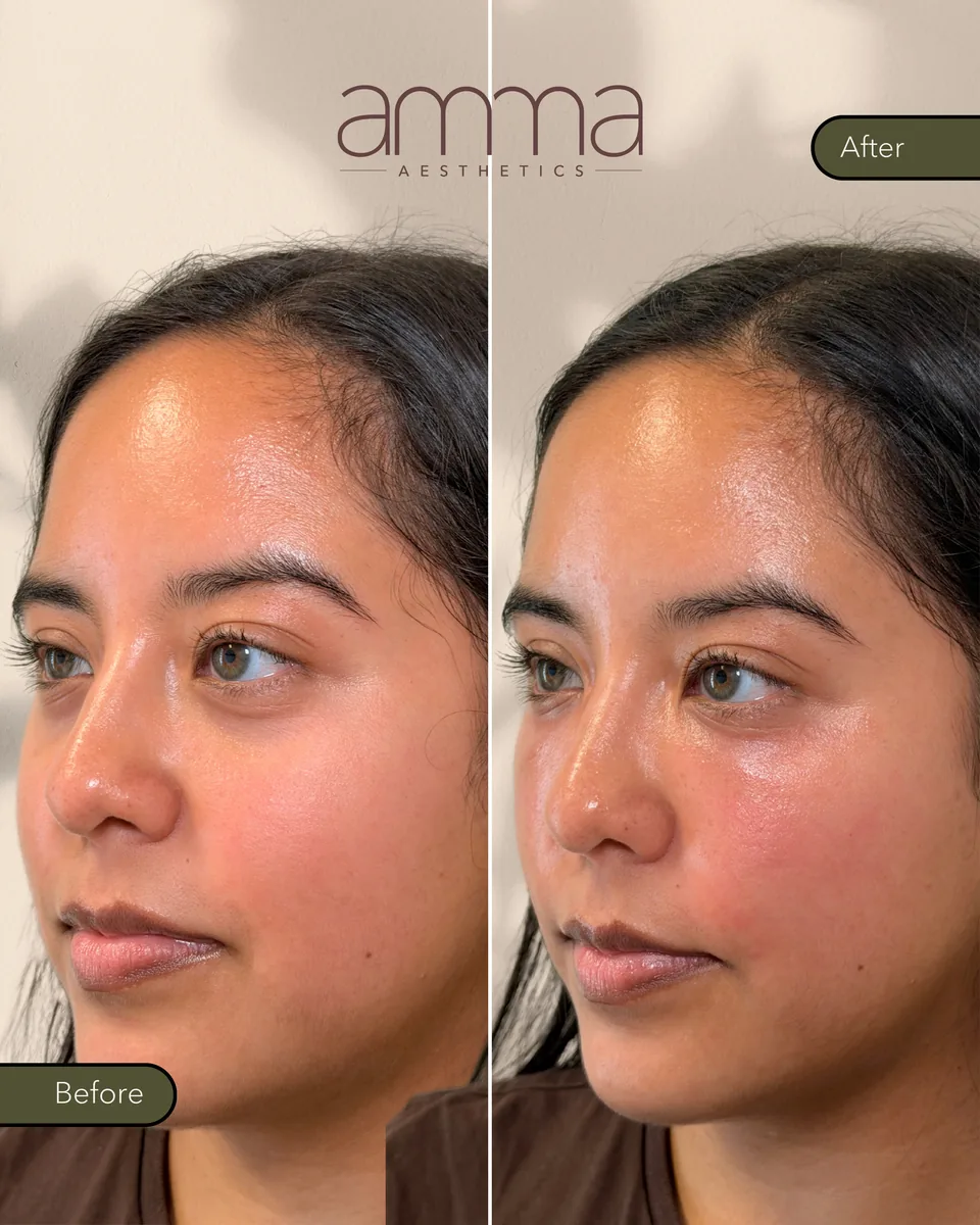 EZGel skin rejuvenation before and after, angled view, at AMMA Aesthetics in South Miami