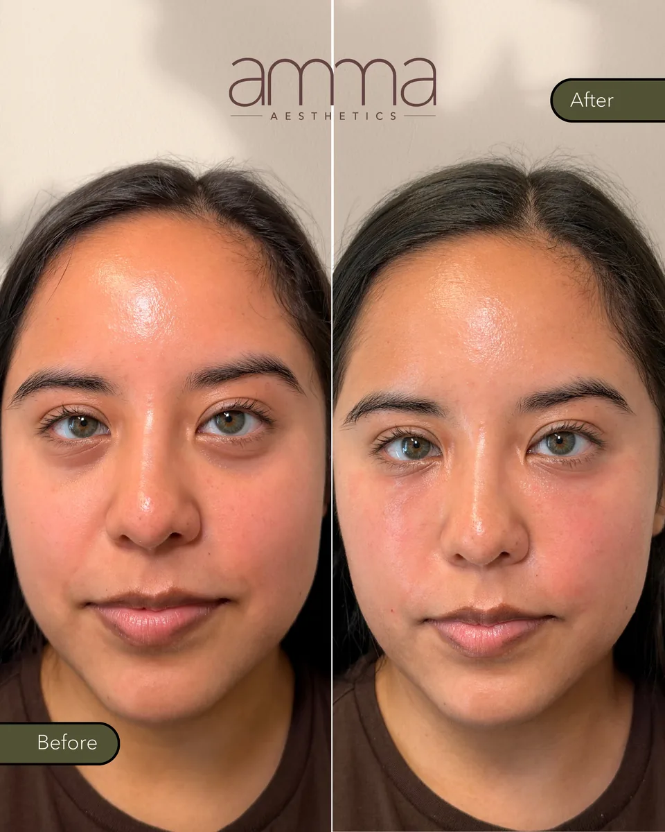 EZGel skin rejuvenation before and after, front view, at AMMA Aesthetics in South Miami
