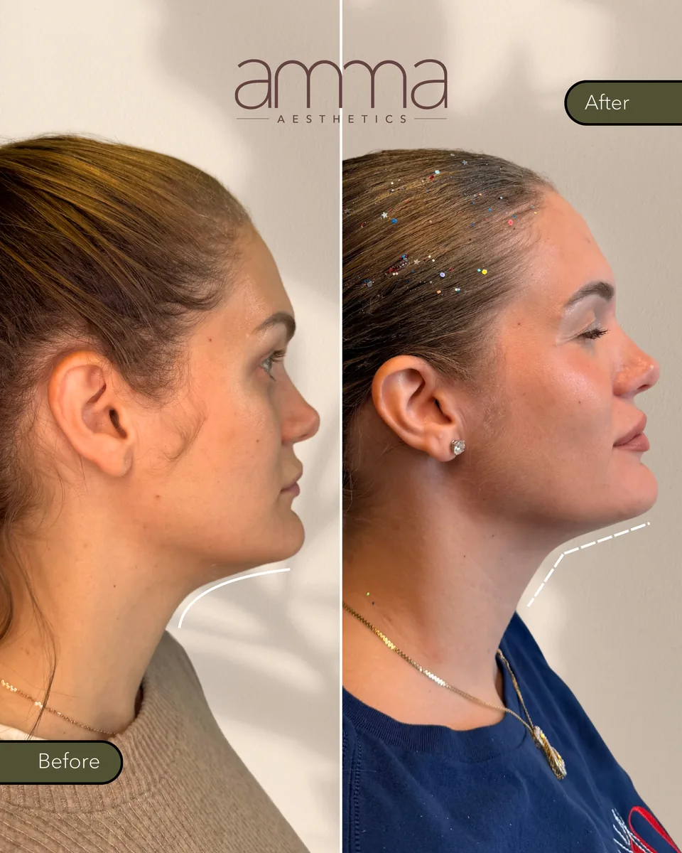 Kybella double chin and jawline before and after, profile view, at AMMA Aesthetics in South Miami