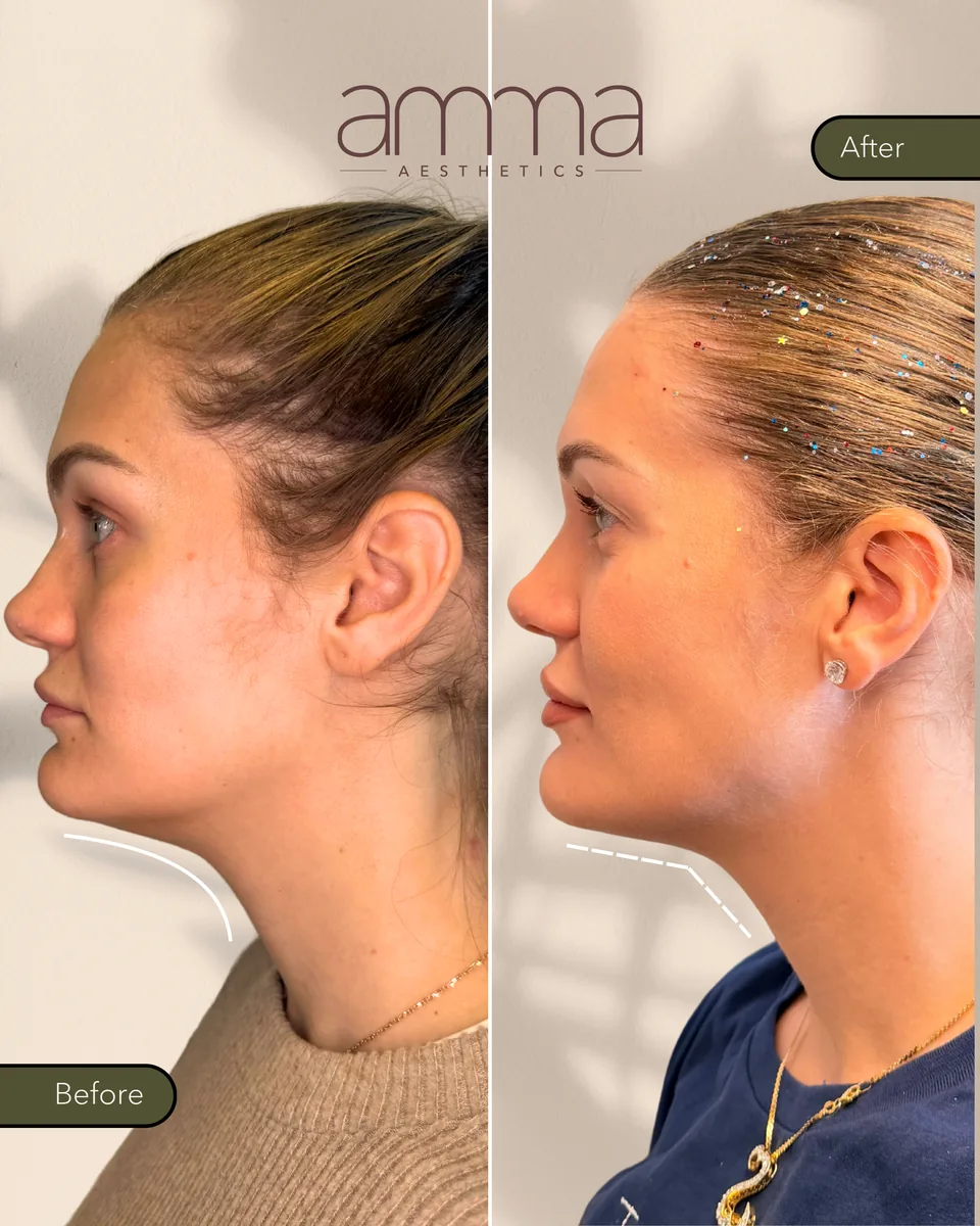 Kybella double chin reduction before and after, profile view, at AMMA Aesthetics in South Miami