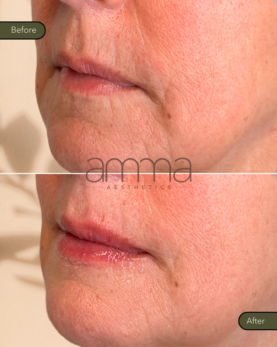 Lip filler before and after on mature lips, side view, at AMMA Aesthetics in South Miami