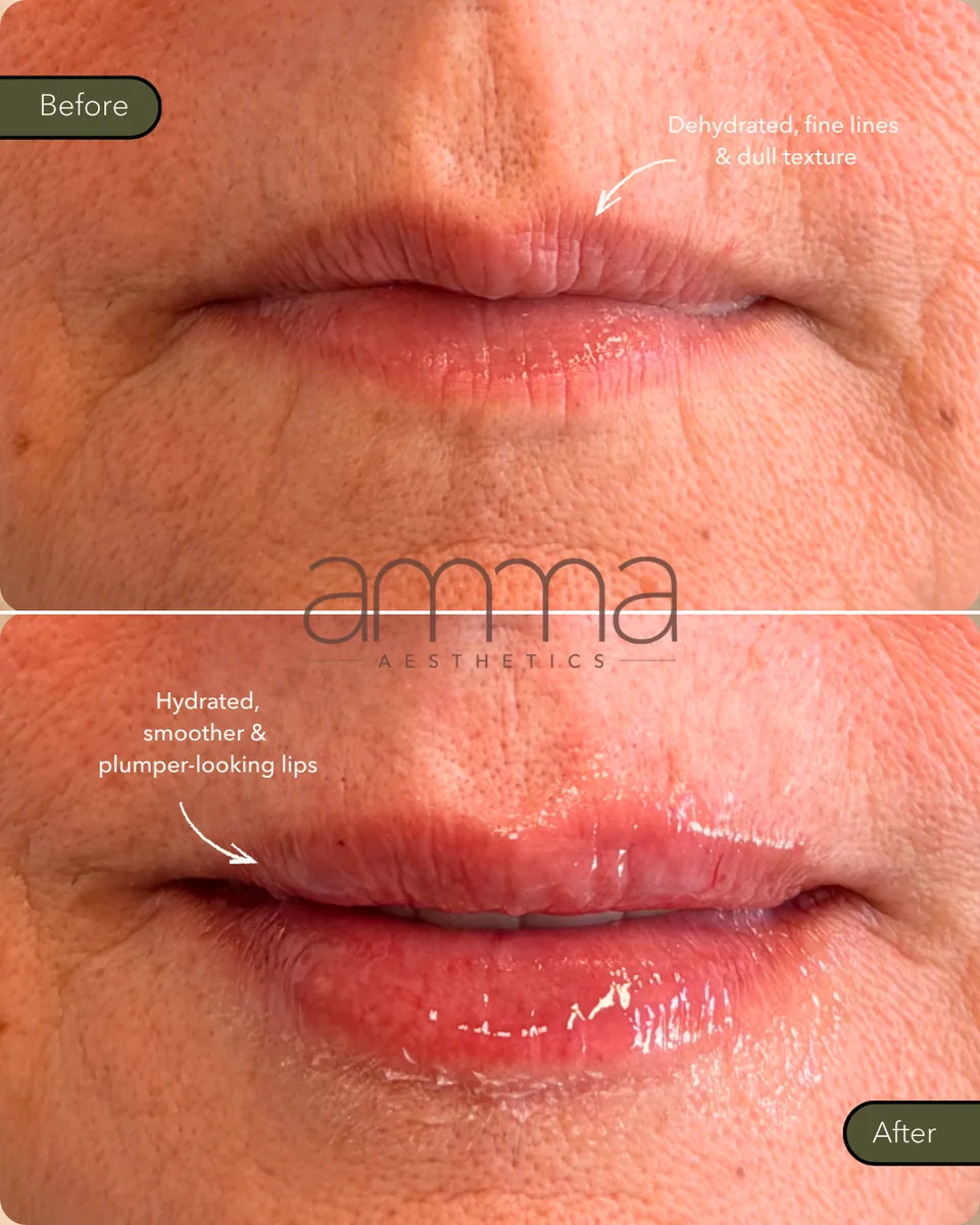 Lip filler before and after on mature lips, smoothing fine lines, at AMMA Aesthetics in South Miami