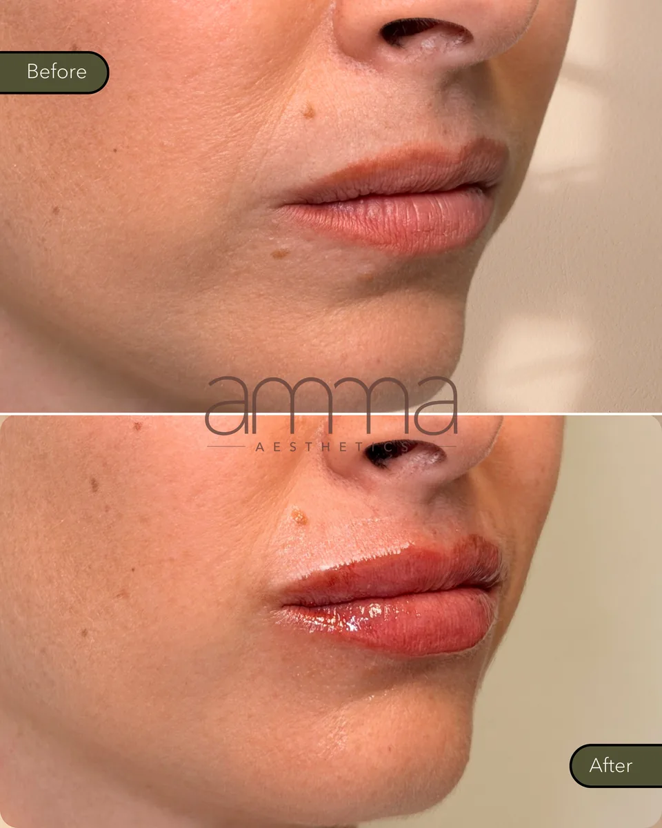 Lip filler before and after, angled view, at AMMA Aesthetics in South Miami